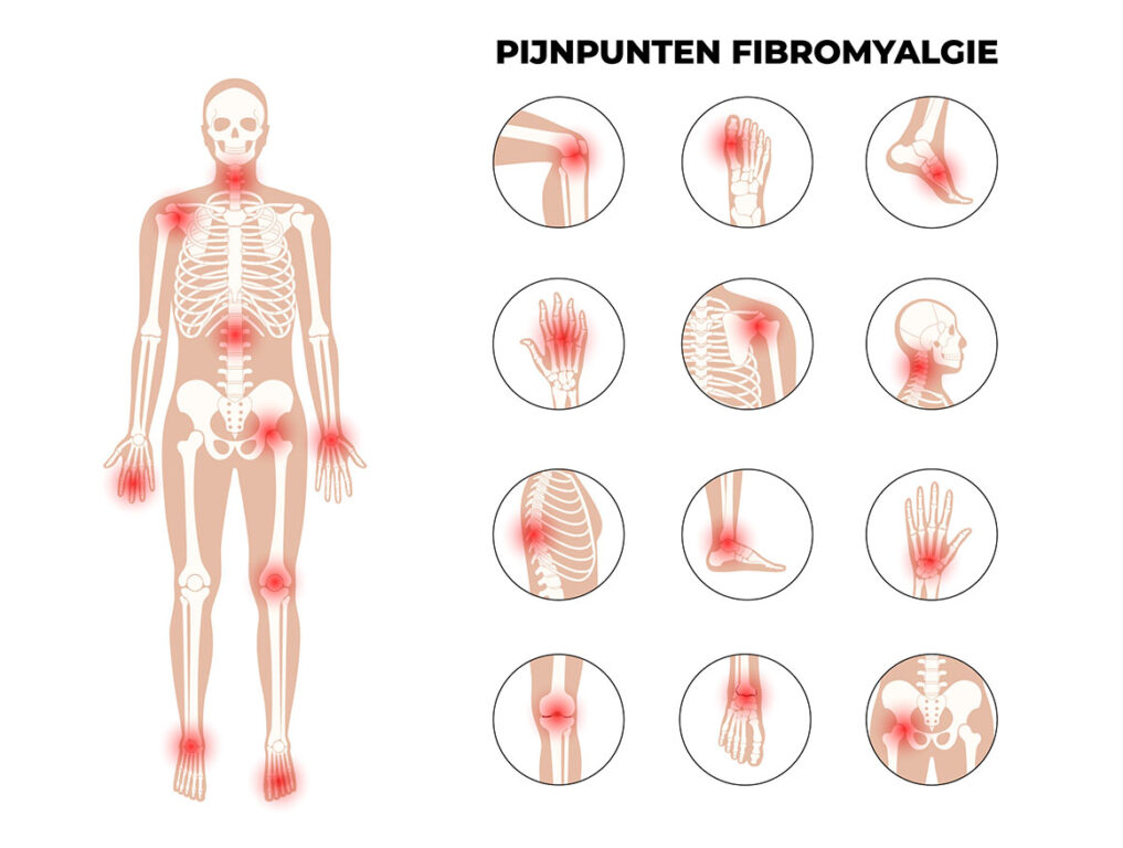Pijnpunten fibromyalgie